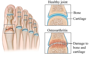 osteoartritis