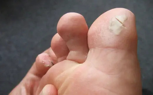 Alcohol's Impact on Foot Health: Recognizing the Risks DrLuigi
