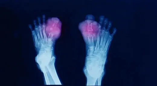 Understanding Tophaceous Gout: Symptoms, Diagnosis, and Treatment DrLuigi